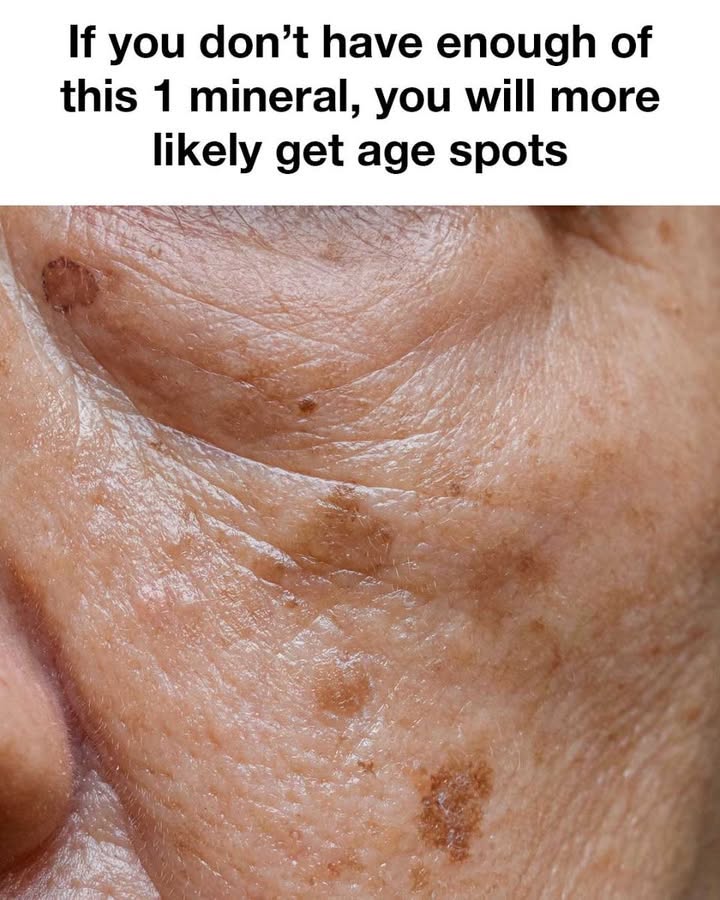 The Number One Deficiency Behind Aging Spots — And How to Naturally Address It Step by Step 🌿 The Number One Deficiency Behind Aging Spots — And How to Naturally Address It Step by Step 🌿