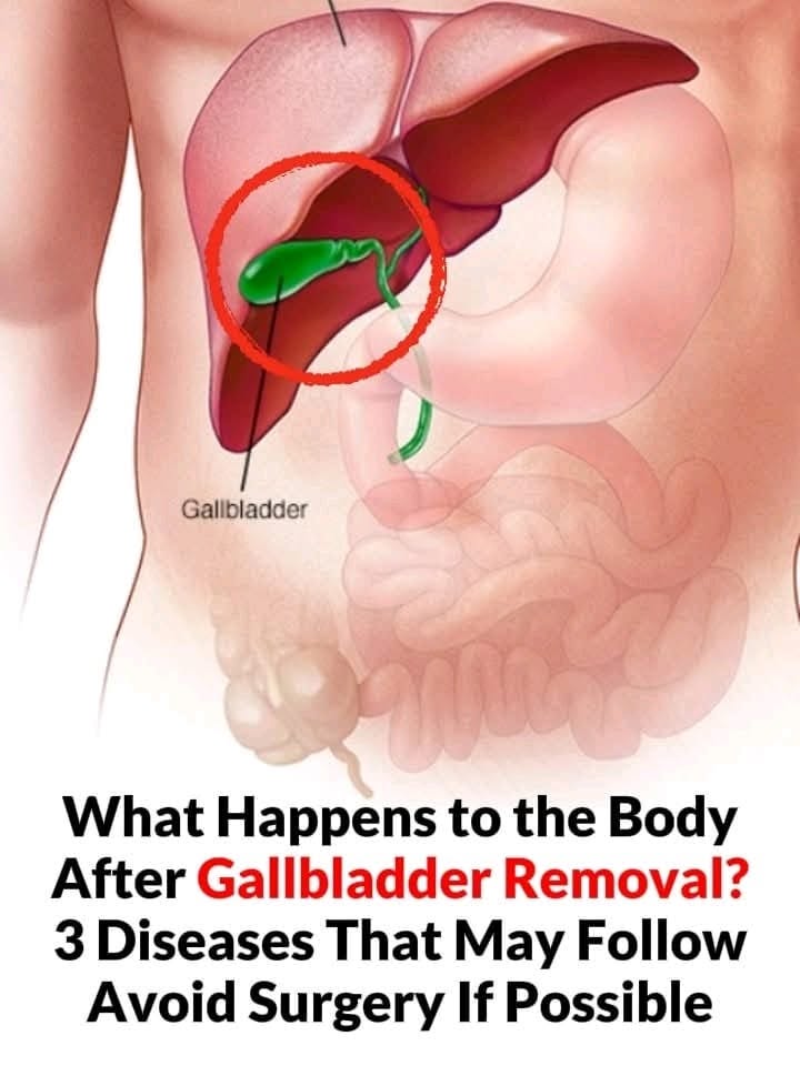 What Happens to the Body After Gallbladder Removal? 3 Diseases That May Follow – Avoid Surgery If Possible What Happens to the Body After Gallbladder Removal? 3 Diseases That May Follow – Avoid Surgery If Possible