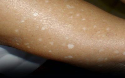 Have You Noticed Small White Spots on Your Arms or Legs? Here’s What They Are