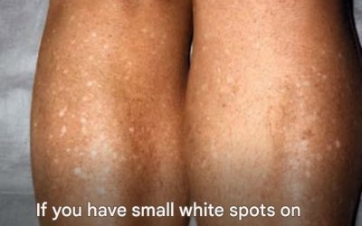 If you have small white spots on your arms or legs, it’s a clear sign that…See more