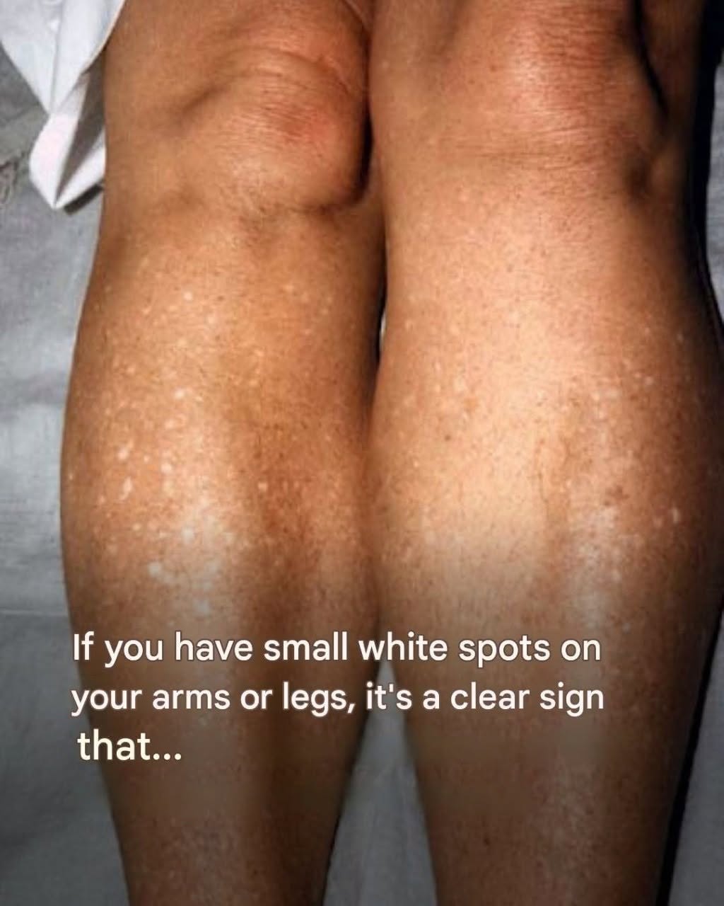 If you have small white spots on your arms or legs, it’s a clear sign that…See more
