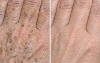 My mom taught me this trick to diminish dark age spots on my hands in just 3 mins with 0 effort. Here’s how it works